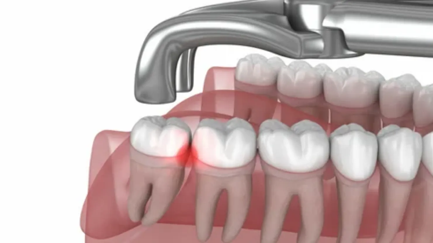 Smooth Transitions Navigating Wisdom Teeth Extraction in Las Vegas