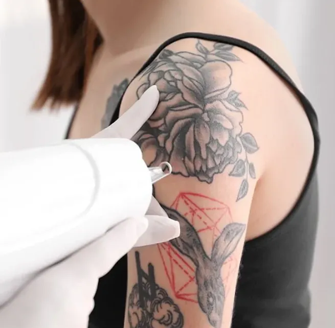 Social Media Influence on Tattoo Removal Decisions