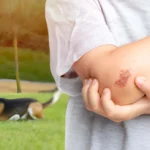 Dog Bite Injuries Can Leave More Than a Wound